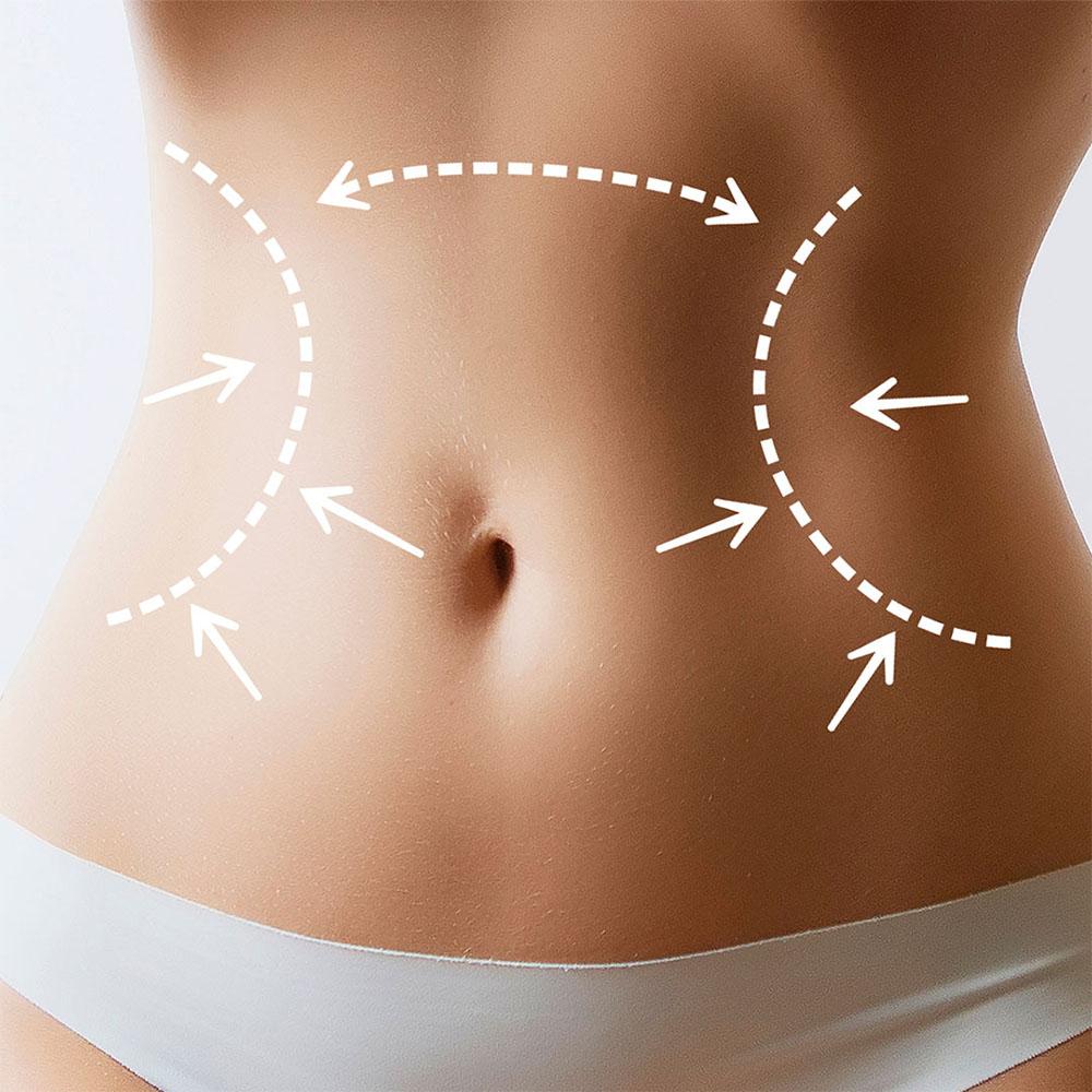 liposuction plastic surgery