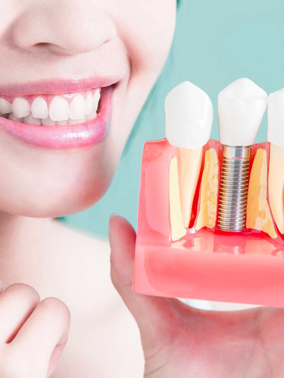 Dental Implant