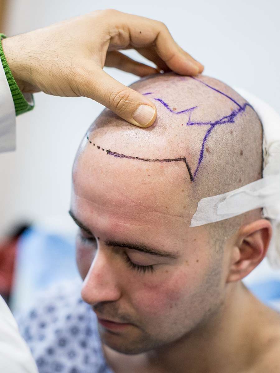 Male Hair Transplant