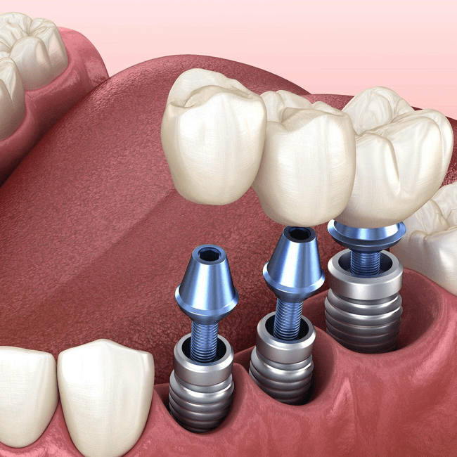 Dental Implant Detail