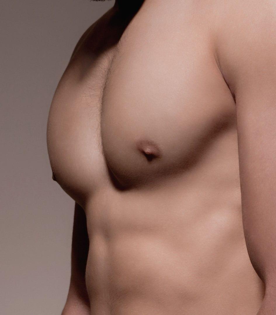 Gynecomastia