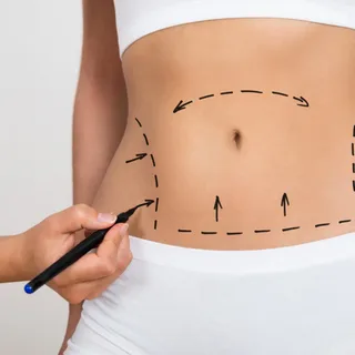 Tummy Tuck