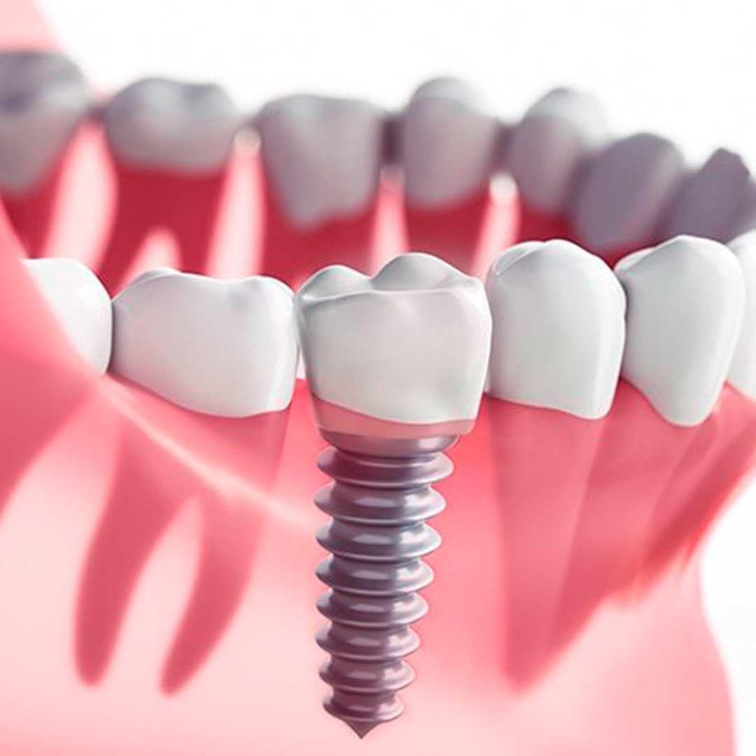 Dental Implant Detail