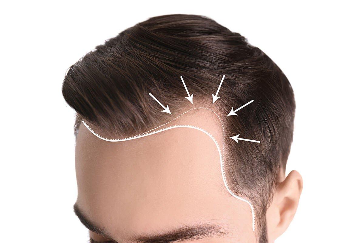 Complete Hair Transplant