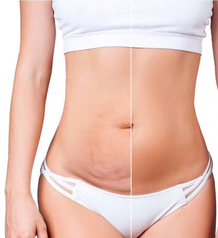 Tummy Tuck