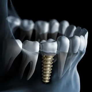 Dental Implant Detail