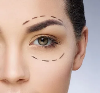 Blepharoplasty Detail