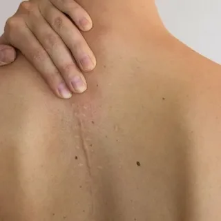 Back Scar Revision Detail