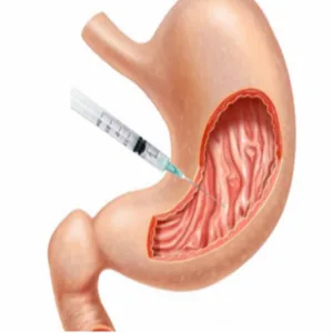 Gastric botox