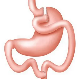 Gastric Bypass