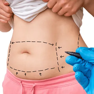 liposuction plastic surgery