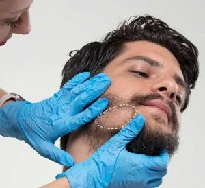 Beard Transplant Detail