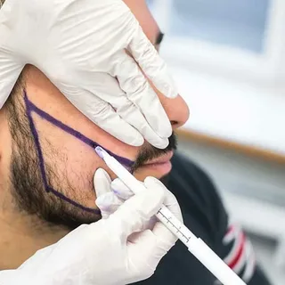 Beard Transplant Detail