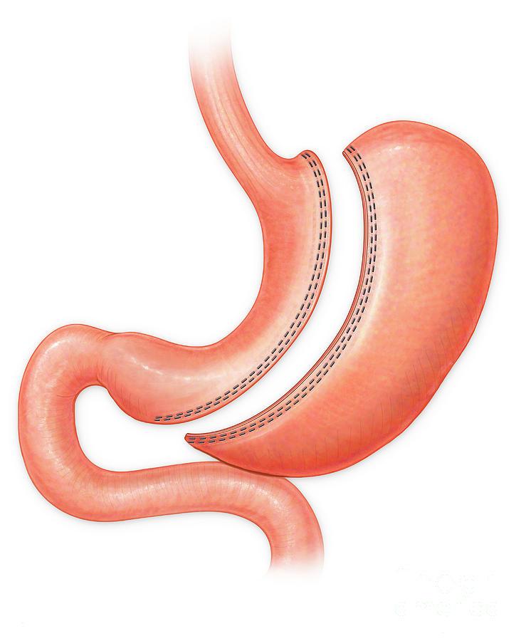 Gastric Sleeves